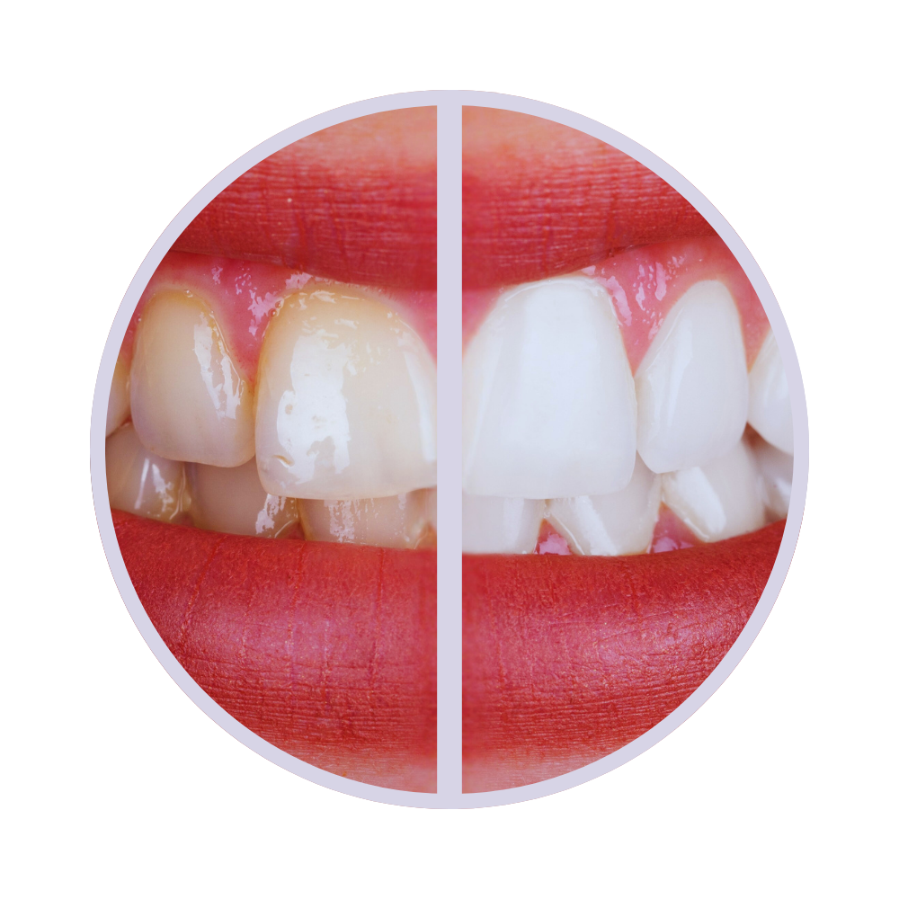 Ivora - Teeth Whitening Serum